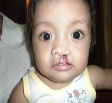 cleft lip before and after. OPERATED BY: BEFORE; AFTER